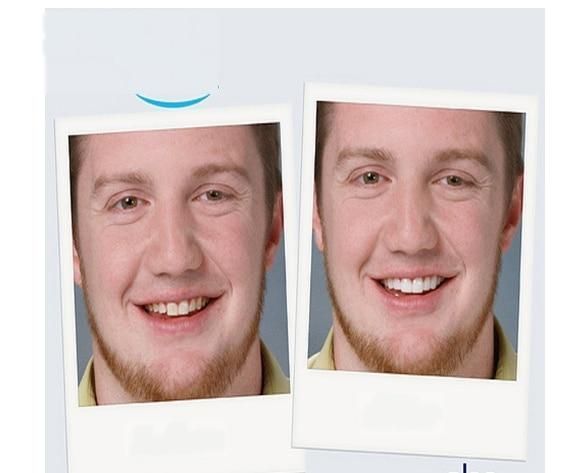 Виниры SnapOn Smile Veneers для зубов снеп он смайл 1 ЧЕЛЮСТЬ VEN286S фото