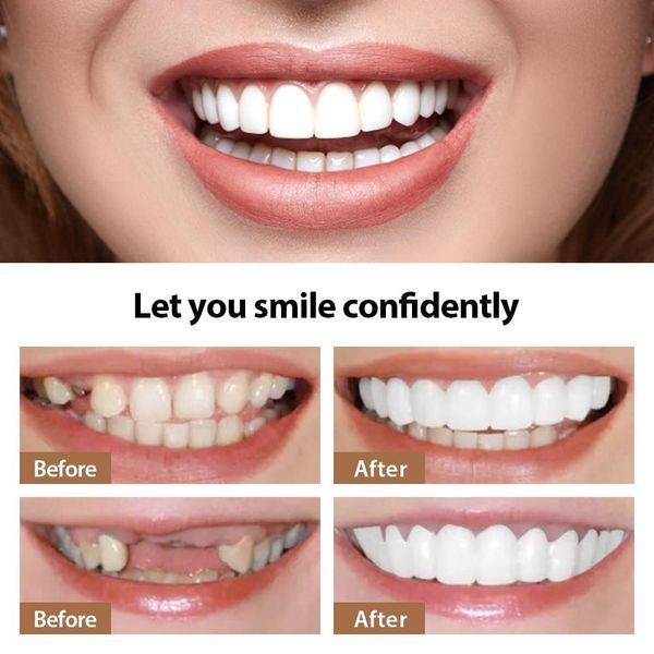 Вініри SnapOn Smile Veneers для зубів сніп він змайл 2 ЧЕЛЮСТІ VEN286B фото